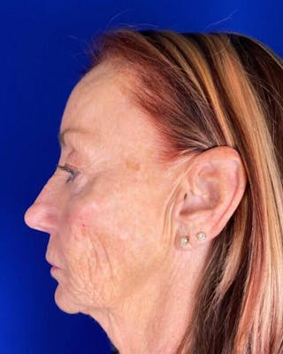 Injectable Cheek Lift Before & After Gallery - Patient 397109 - Image 6