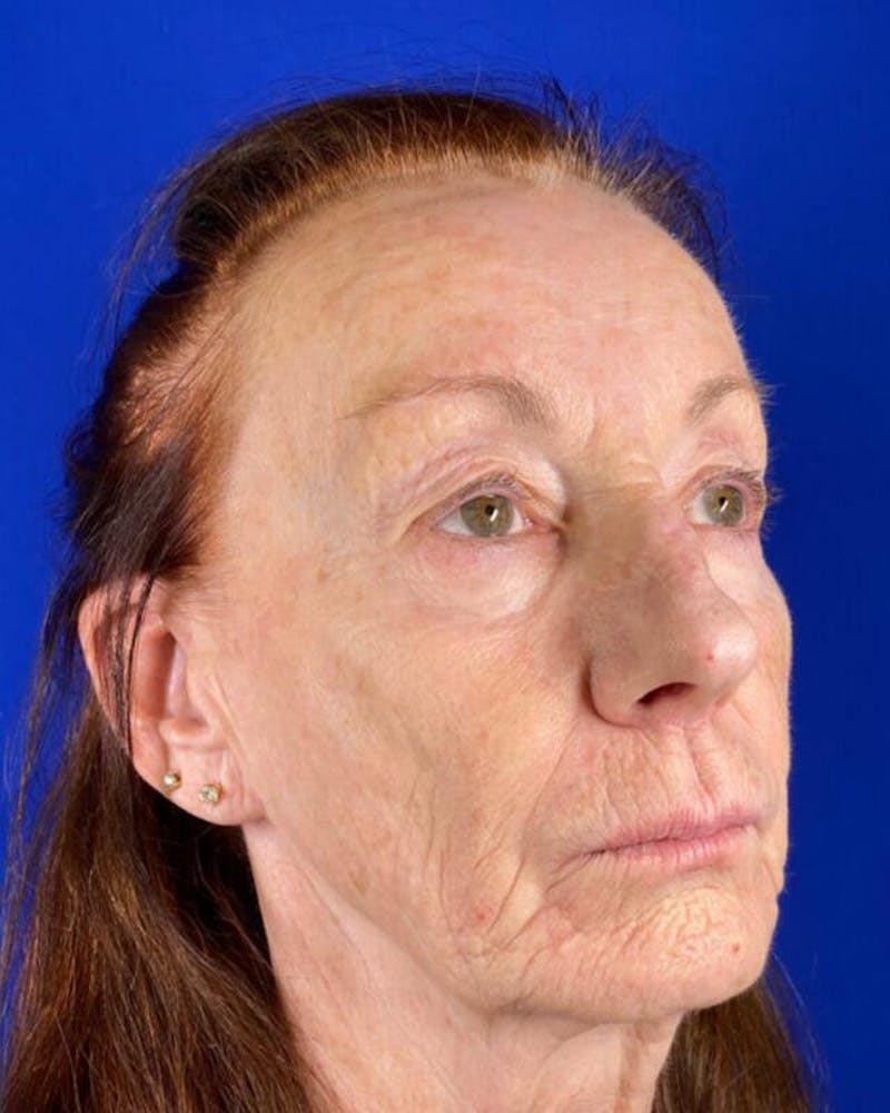 Injectable Cheek Lift Before & After Gallery - Patient 397109 - Image 7
