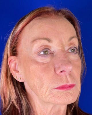 Injectable Cheek Lift Before & After Gallery - Patient 397109 - Image 8