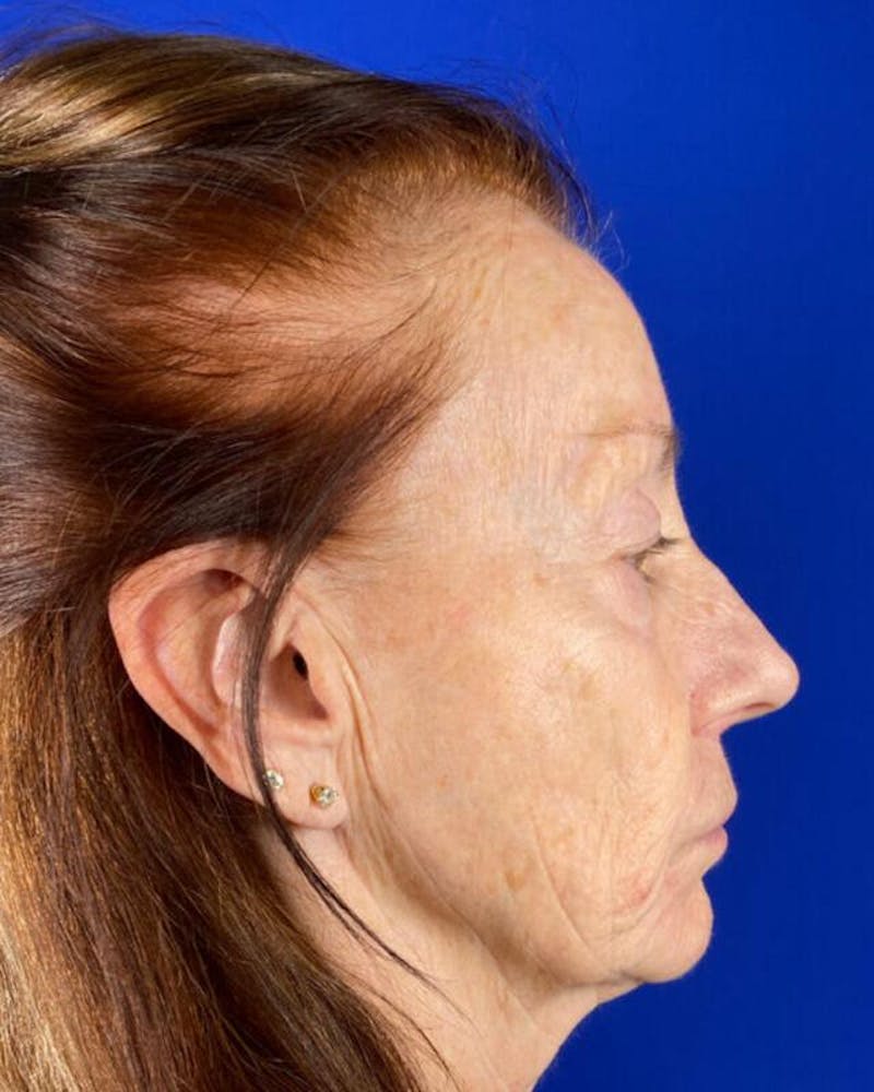 Injectable Cheek Lift Before & After Gallery - Patient 397109 - Image 9
