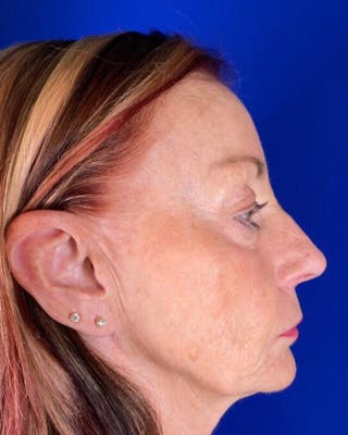 Injectable Cheek Lift Before & After Gallery - Patient 397109 - Image 10