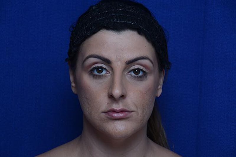 Injectable Cheek Lift Before & After Gallery - Patient 172626 - Image 1
