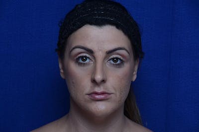 Injectable Cheek Lift Before & After Gallery - Patient 172626 - Image 1