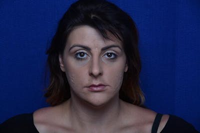 Injectable Cheek Lift Before & After Gallery - Patient 172626 - Image 2