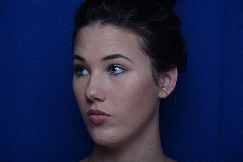 Injectable Cheek Lift Before & After Gallery - Patient 345244 - Image 3