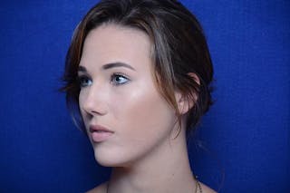 Injectable Cheek Lift Before & After Gallery - Patient 345244 - Image 4