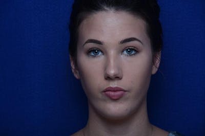 Injectable Cheek Lift Before & After Gallery - Patient 345244 - Image 1