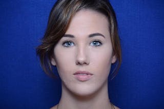 Injectable Cheek Lift Before & After Gallery - Patient 345244 - Image 2