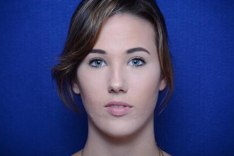 Injectable Cheek Lift Before & After Gallery - Patient 345244 - Image 2