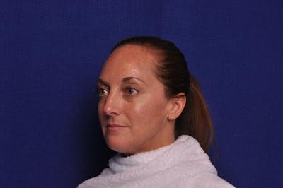 Injectable Cheek Lift Before & After Gallery - Patient 394666 - Image 1