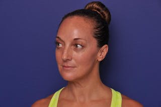 Injectable Cheek Lift Before & After Gallery - Patient 394666 - Image 2