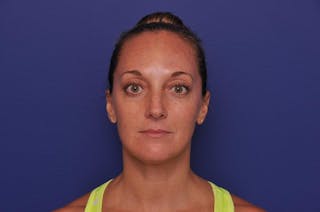 Injectable Cheek Lift Before & After Gallery - Patient 394666 - Image 4