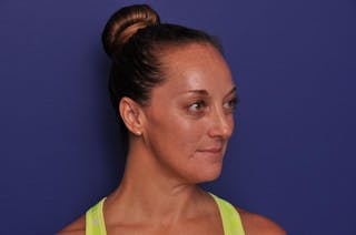 Injectable Cheek Lift Before & After Gallery - Patient 394666 - Image 6