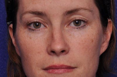 Injectable Cheek Lift Before & After Gallery - Patient 277350 - Image 1