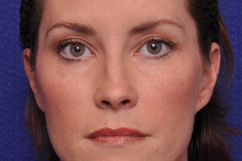 Injectable Cheek Lift Before & After Gallery - Patient 277350 - Image 2