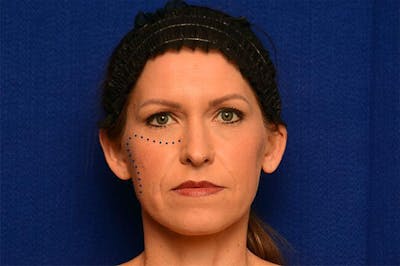 Injectable Cheek Lift Before & After Gallery - Patient 325198 - Image 1