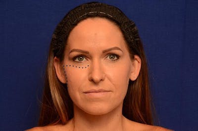 Injectable Cheek Lift Before & After Gallery - Patient 325198 - Image 2