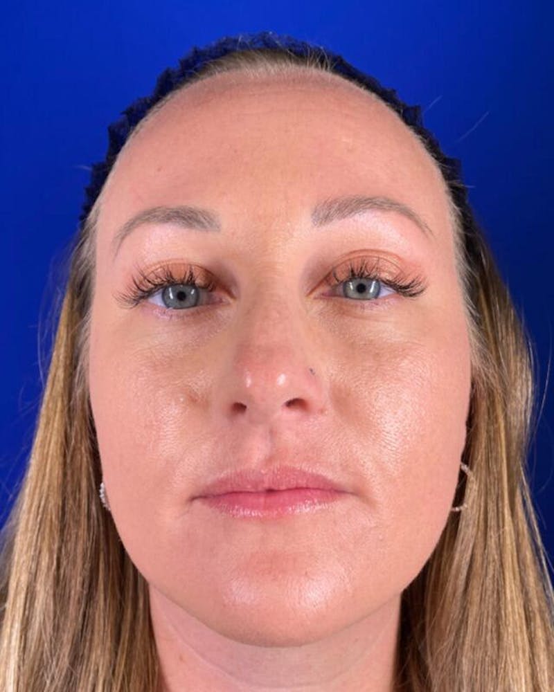 Injectables Before & After Gallery - Patient 198973 - Image 1