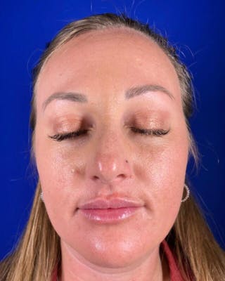 Injectables Before & After Gallery - Patient 198973 - Image 2