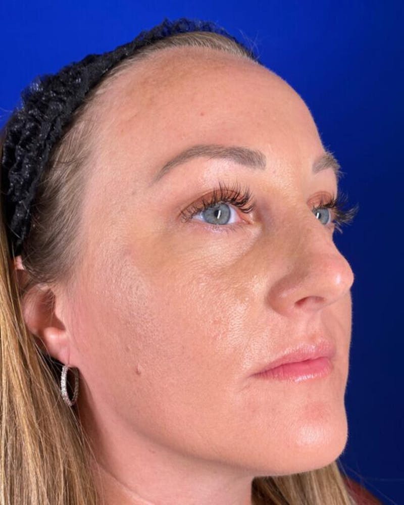 Injectables Before & After Gallery - Patient 198973 - Image 3