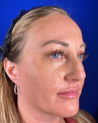 Injectables Before & After Gallery - Patient 198973 - Image 4