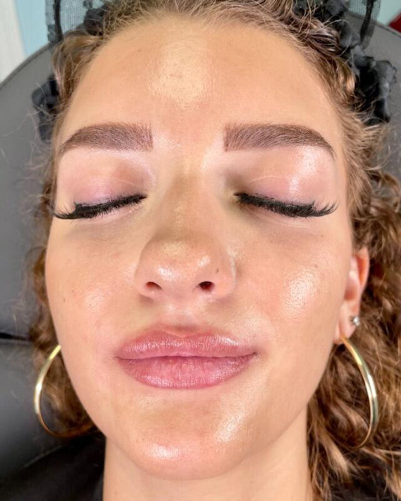 Injectables Before & After Gallery - Patient 398707 - Image 1