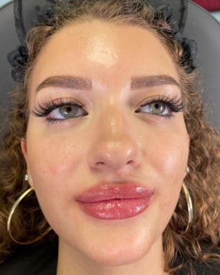 Injectables Before & After Gallery - Patient 398707 - Image 2