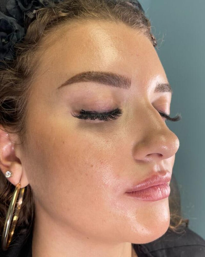 Injectables Before & After Gallery - Patient 398707 - Image 3