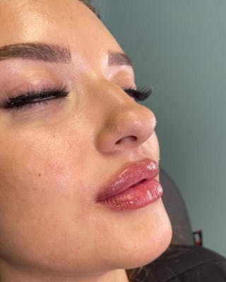 Injectables Before & After Gallery - Patient 398707 - Image 4