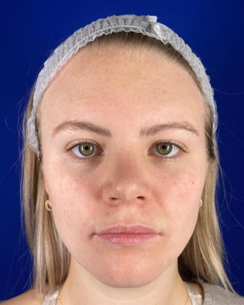 Injectables Before & After Gallery - Patient 342237 - Image 1