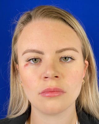 Injectables Before & After Gallery - Patient 342237 - Image 2