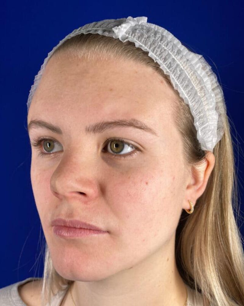 Injectables Before & After Gallery - Patient 342237 - Image 3