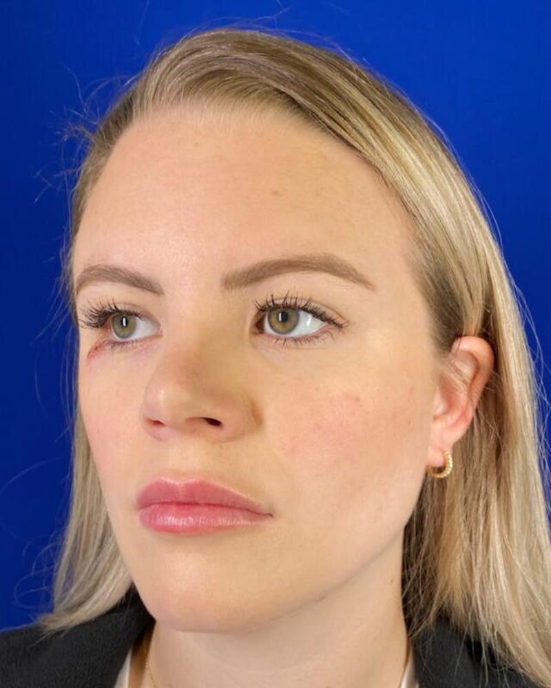 Injectables Before & After Gallery - Patient 342237 - Image 4