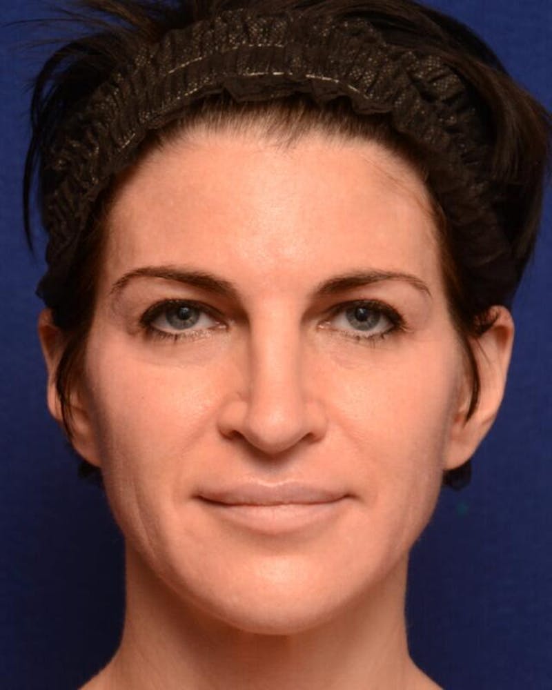 Injectables Before & After Gallery - Patient 170773 - Image 1