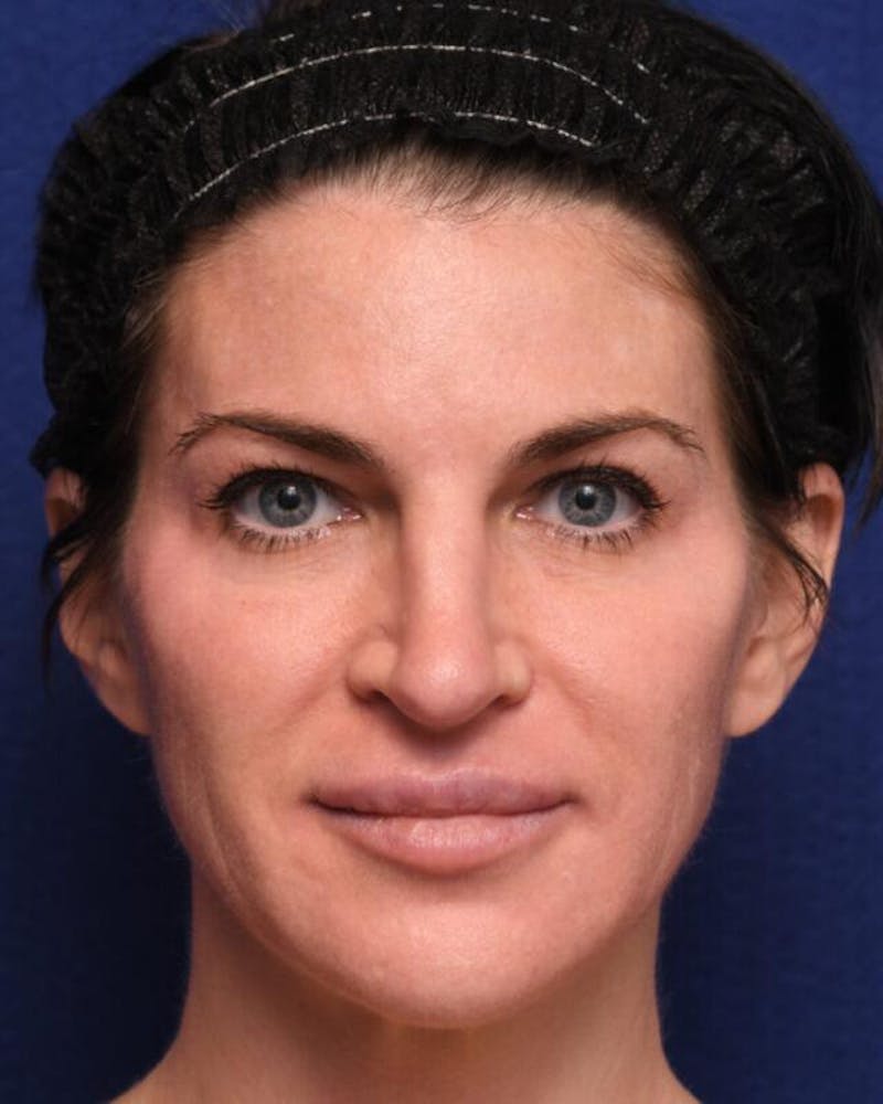 Injectables Before & After Gallery - Patient 170773 - Image 2