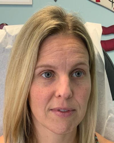 Injectables Before & After Gallery - Patient 264393 - Image 1