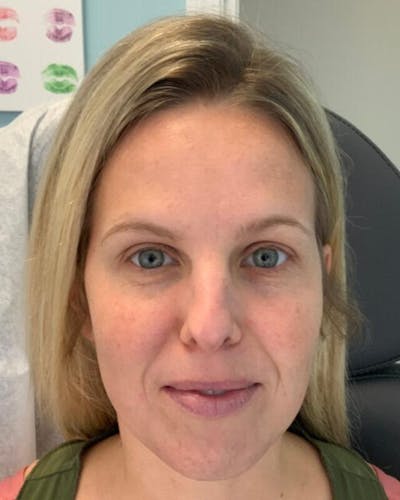 Injectables Before & After Gallery - Patient 264393 - Image 2