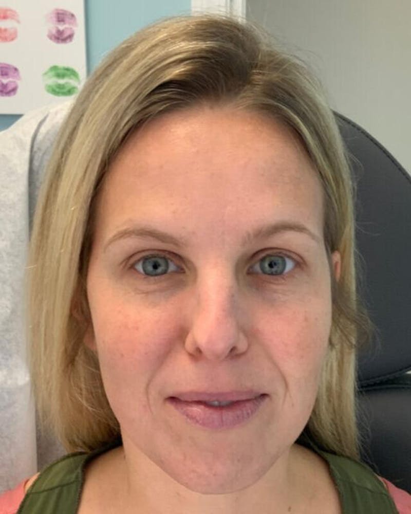 Injectables Before & After Gallery - Patient 264393 - Image 2