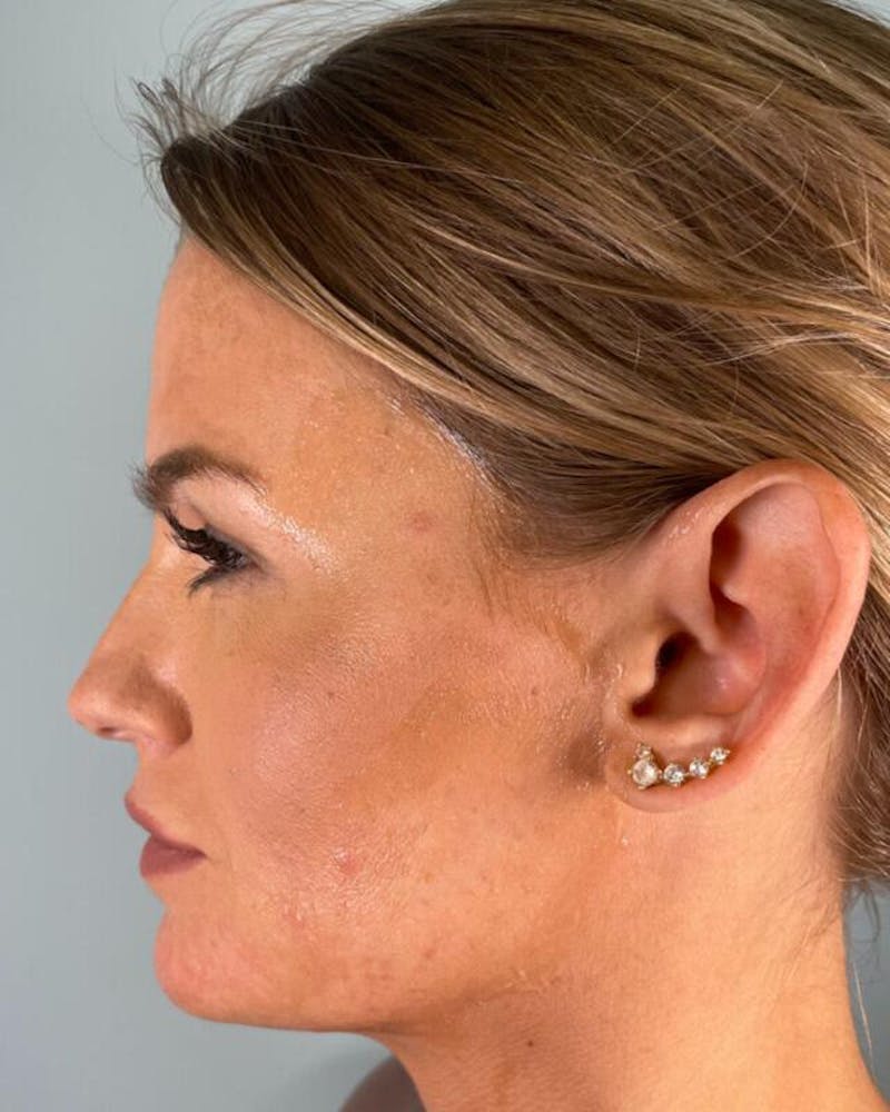 Injectables Before & After Gallery - Patient 342770 - Image 1