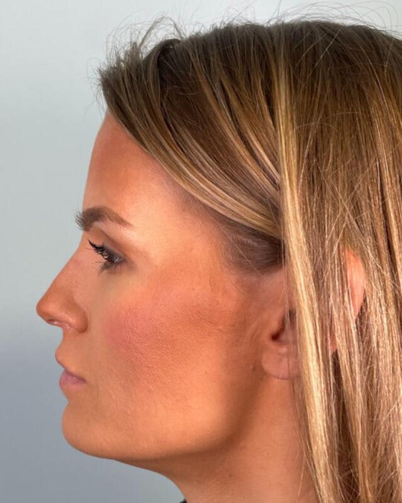 Injectables Before & After Gallery - Patient 342770 - Image 2