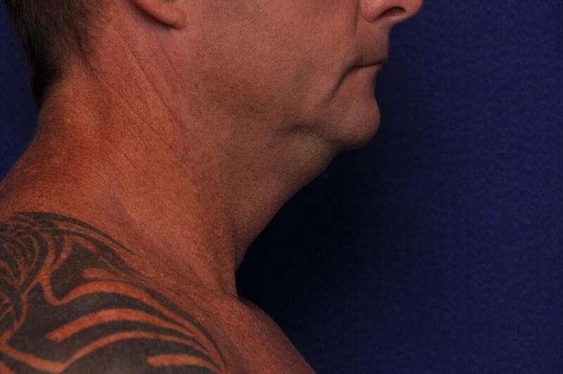 Kybella Before & After Gallery - Patient 397247 - Image 1