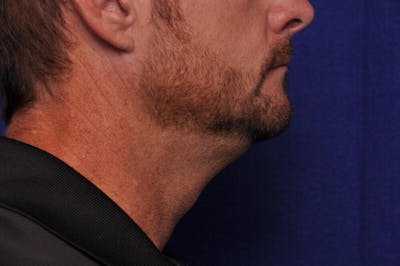 Kybella Before & After Gallery - Patient 397247 - Image 2