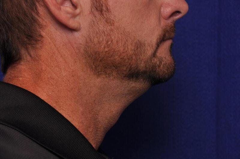 Kybella Before & After Gallery - Patient 397247 - Image 2