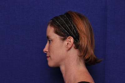 Liquid Facelift Before & After Gallery - Patient 290529 - Image 1
