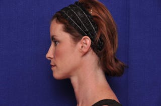 Liquid Facelift Before & After Gallery - Patient 290529 - Image 2
