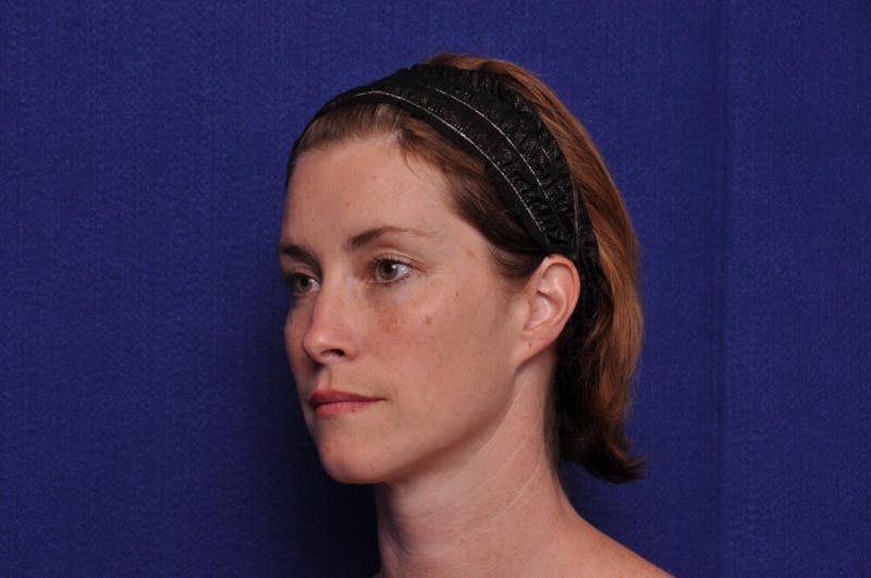 Liquid Facelift Before & After Gallery - Patient 290529 - Image 3