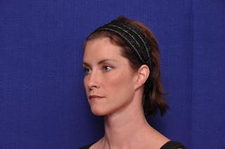 Liquid Facelift Before & After Gallery - Patient 290529 - Image 4