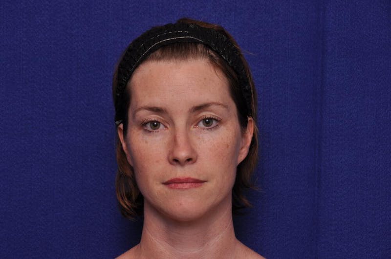 Liquid Facelift Before & After Gallery - Patient 290529 - Image 5
