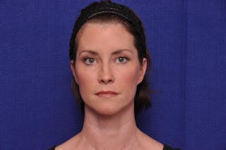 Liquid Facelift Before & After Gallery - Patient 290529 - Image 6