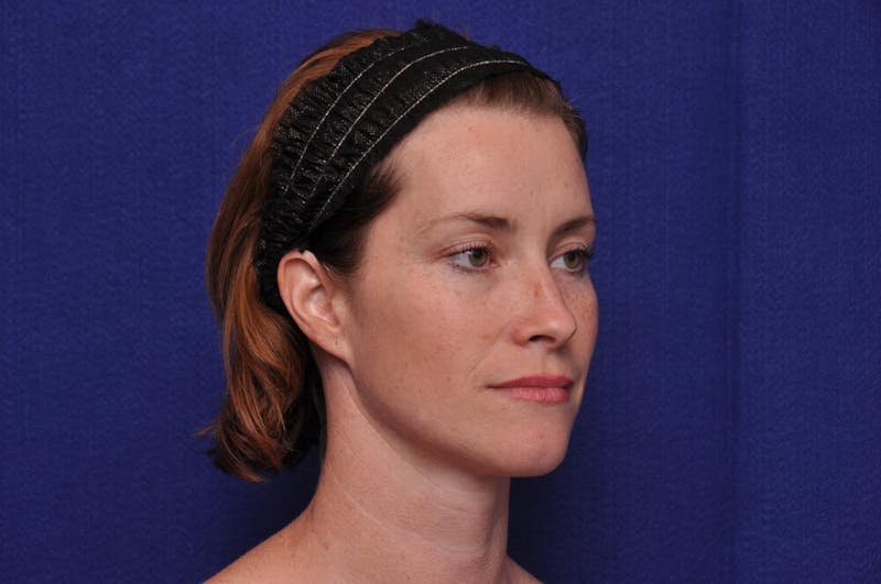 Liquid Facelift Before & After Gallery - Patient 290529 - Image 7